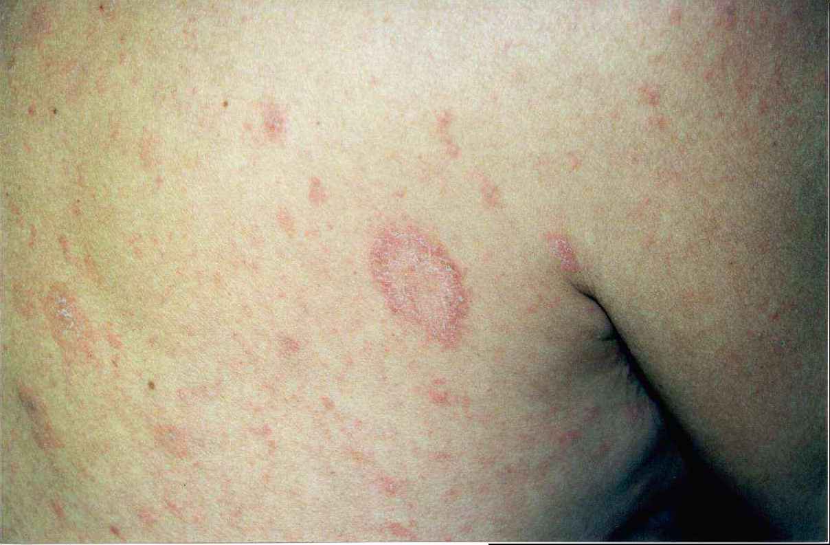 Pityriasis rosea (patientenfolder) - huidziekten.nl