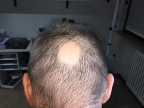 Alopecia areata