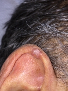 Condrodermatite elice