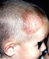 Tinea capitis